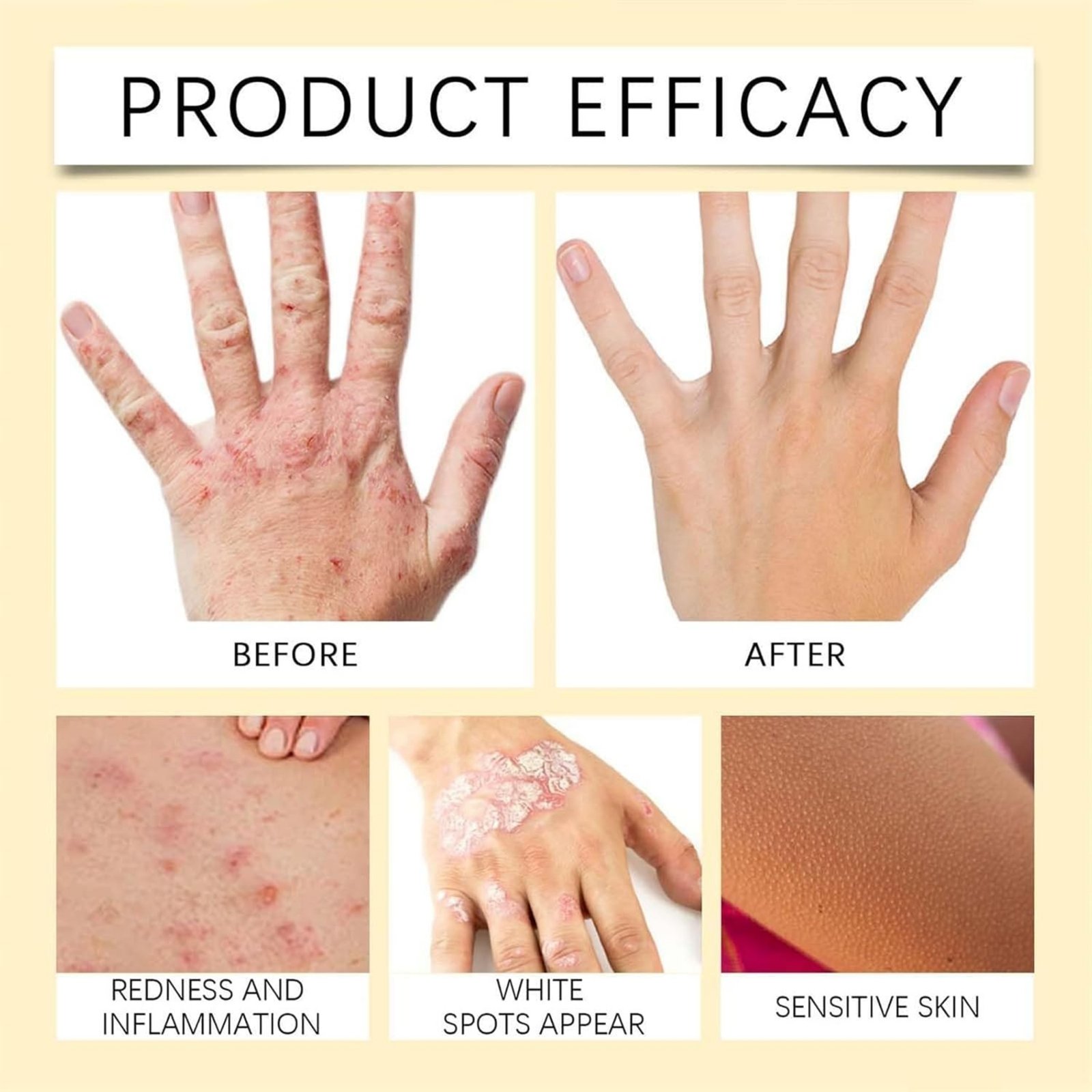 Vitigo Bee Venom Treatment Cream | Natural Skin Repair Hydration Relief Anti-Irritation - Image 8